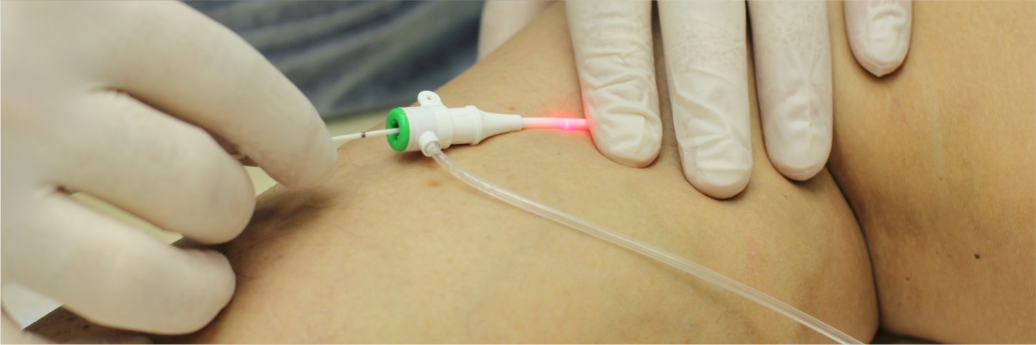 Лазерное лечение варикоза